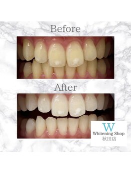 ホワイトニングショップ 秋田店/【before after】 美白