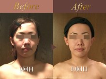 オーシャン(Ocean)/徹底改善コース/週2回×10回