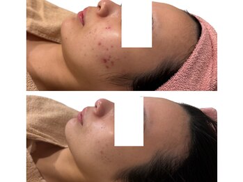 ラシック(La chic)/クリスティーナ/ニキビケア/美白