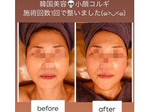 【左右非対称改善】頭蓋骨リフト＆頭筋解し＋顔筋運動◎#桑名市