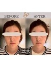 チョコバリ 錦糸町店(chocobari)/小顔×リフトアップ(美容鍼)20代