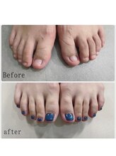 ティアラネイル 宇都宮/深爪矯正　フット