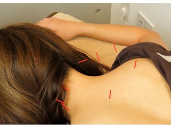 ムラサキ鍼灸治療院(MURASAKI鍼灸治療院)/慢性的な首肩こりに