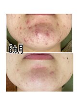 イネスプライベートスペース(Ines)/大人ニキビケアに多い口周りです