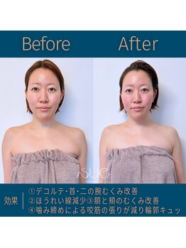 スー(Sue)/中顔面短縮インディバ得意です♪