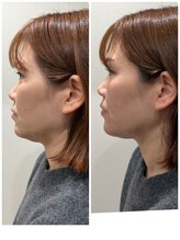 メディカルエース(MedicalAce)/ブライティングリフト