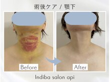 アピ(api)/症例写真【インディバ】