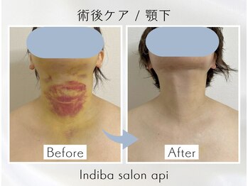 アピ(api)/症例写真【インディバ】