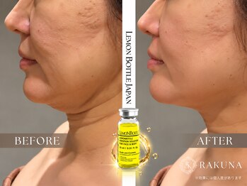 ラクナ(RAKUNA)の写真/レモンボトルで二重あご・たるみ・もたつき・脂肪へアプローチ！Eラインを整える贅沢体験♪