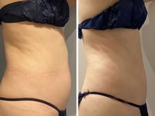 エイシスグロウ(asis glow.)/効果写真