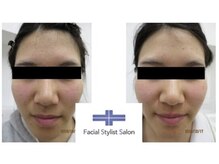 フェイシャルスタイリストサロン 四谷店/ケア例(13)