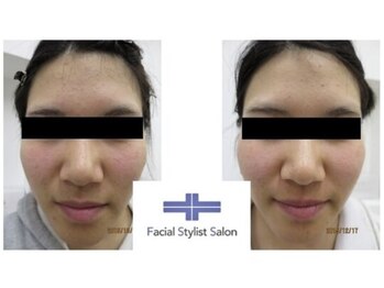 フェイシャルスタイリストサロン 四谷店/ケア例(13)