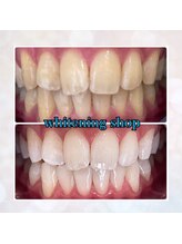 ホワイトニングショップ 鳳店/ご新規様クーポン