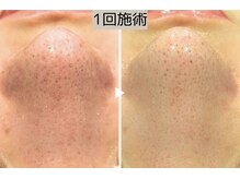 ロワ(Roi)の雰囲気（【毛穴洗浄+光フェイシャル】引き締めて毛穴汚れに悩まない肌に）