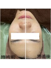 カヌヌ(Kanunu)/肌質改善トリートメント