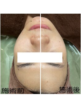 カヌヌ(Kanunu)/肌質改善トリートメント