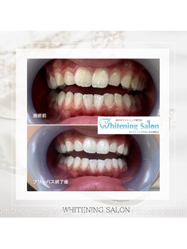 ホワイトニングサロン 名古屋駅店/【ホワイトニング施術例】