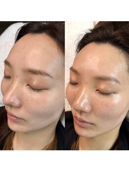 マナ ワクシング 海浜幕張(Mana waxing)/ツヤ肌wax/フェイシャルwax/幕張