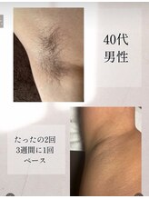 エイビー(ei-B)/【脱毛初心者様も】まずは脇脱毛