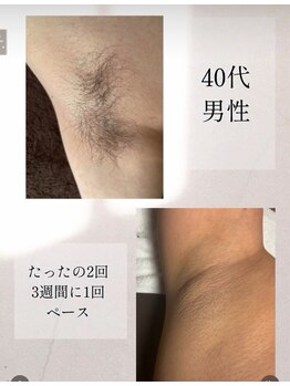 エイビー(ei-B)/【脱毛初心者様も】まずは脇脱毛