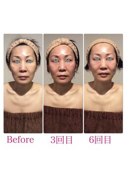 TKC 東京小顔センター五反田店/ビフォーアフター【小顔/首長】