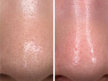 ラティエ(Latier)/毛穴美人！黒ずみ抹殺はハーブで