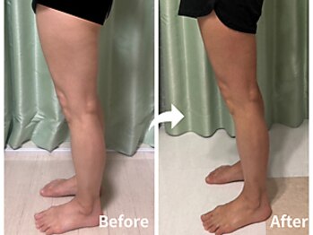 サロンドモモ(SALON de MOMO)/脂肪冷却★脚ビフォーアフター