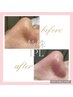 【毛穴・黒ずみ】水光ハイドラ毛穴洗浄+韓国特殊IPL肌管 13,000円→6,980円