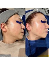 bou 新宿/気づきにくい横顔もスッキリ！