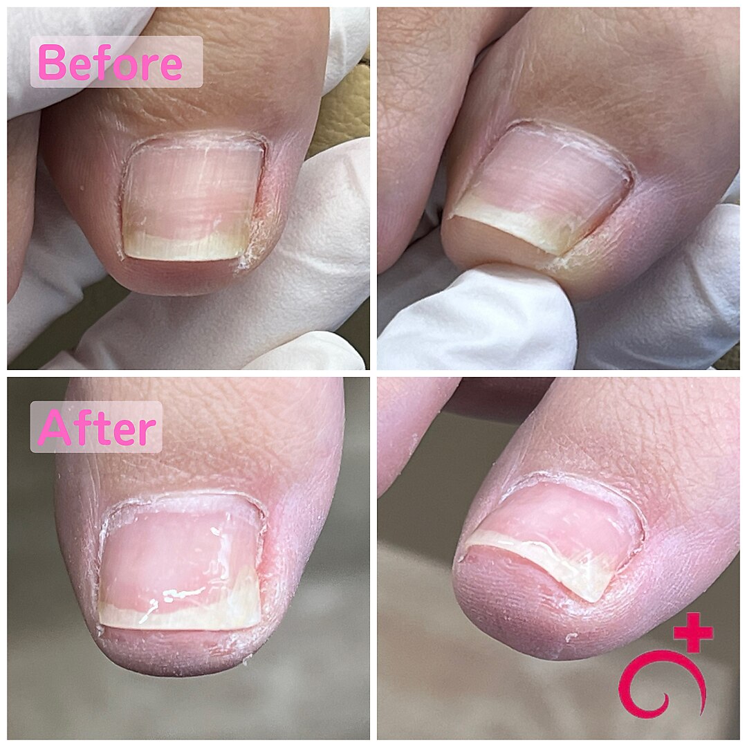 【回数券ご購入者限定】ご予約フォーム　巻き爪