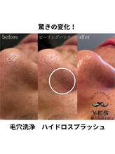イエス 佐賀店(YES)/毛穴洗浄ビフォーアフター