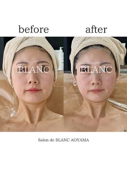 サロン ド ブラン アオヤマ(Salon de BLANC AOYAMA)/BIOPHYTO×韓国美容機器ソノケア