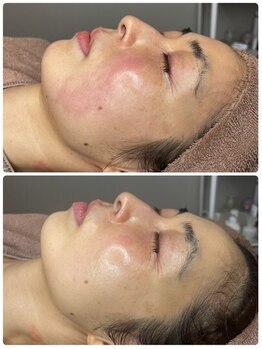 ホワイトアクア つくば店(WHITE AQUA)/ララピール/ つくば/茨城/肌改善