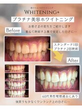 ホワイトニングプラス(Whitening+)/男性もホワイトニング