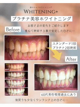 ホワイトニングプラス(Whitening+)/男性もホワイトニング