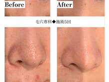 フレイヤ(FREYA)/毛穴専科Before→After