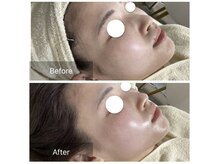 ダリア(Dahlia)/ハーブピーリング