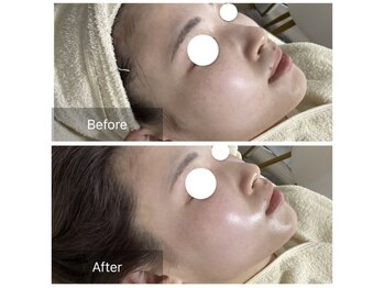 ダリア(Dahlia)/ハーブピーリング