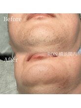 サロンロン 横浜関内(SALON RON)/髭/美容電気脱毛