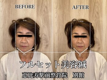 恵比寿駅前整骨院はり院 別館/美容鍼　小顔　リフトアップ