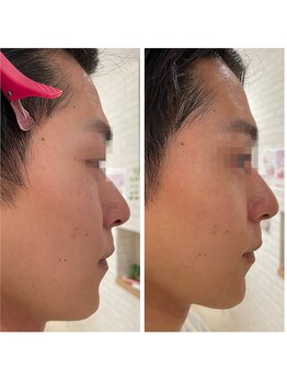 シャンディ(Shandy)/1回のジェルエステでスッキリ◎