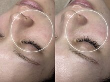 キヌ(KINU)/症例写真（赤み）