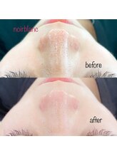 ノワール ブラン(Noir blanc)/ハイドロピーリング