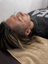 田中整骨鍼灸院 福岡白金院/メンズ美容鍼も大人気★