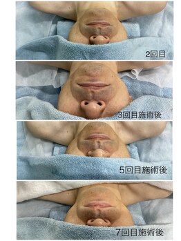 ウルーフ(ulu-fu)/【メンズ髭】爆抜け