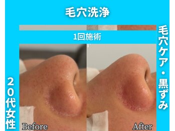 イーラボ 池袋店(e-LABO)/毛穴洗浄/ハイドロフェイシャル