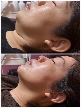 ビマリア(美-MARIA)/プラズマ＋レモンボトル