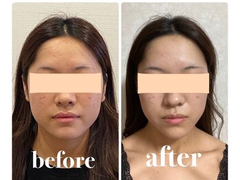 クリーム 京都店(Cream)/アゴの形を変える希少なエステ