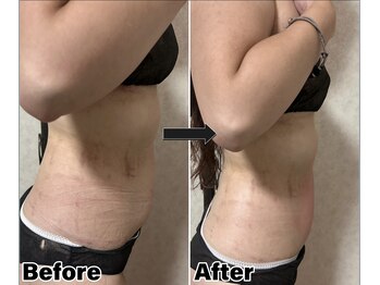 カピリナ(Kapilina)/ WINBACK90 1回【40代女性】