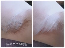 サロン ド モア(salon de MORE)/脇のワックス＋光